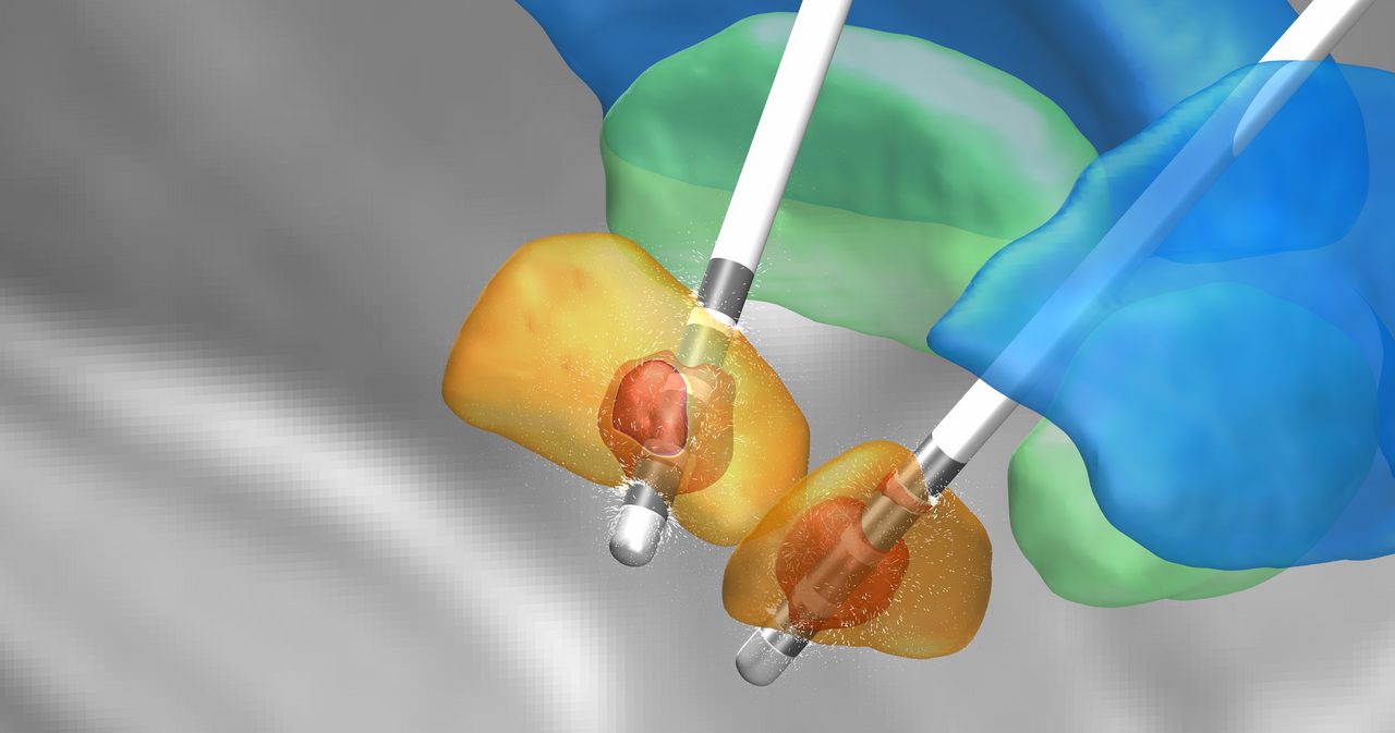 https://www.sfb1315.de/wp-content/uploads/2024/07/Deep_brain_stimulation_in_a_Parkinsons_Disease_patient.jpg